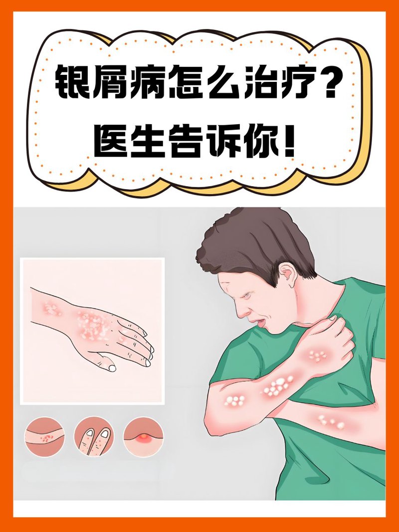 湿疹医院：如何找到最适合自己的治疗方法