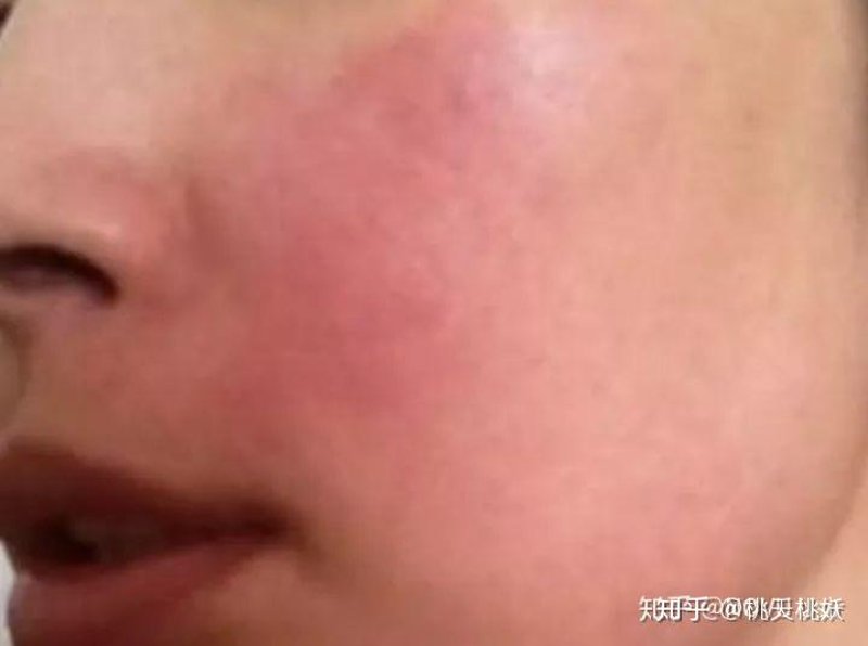 湿疹医院：选择专业的力量