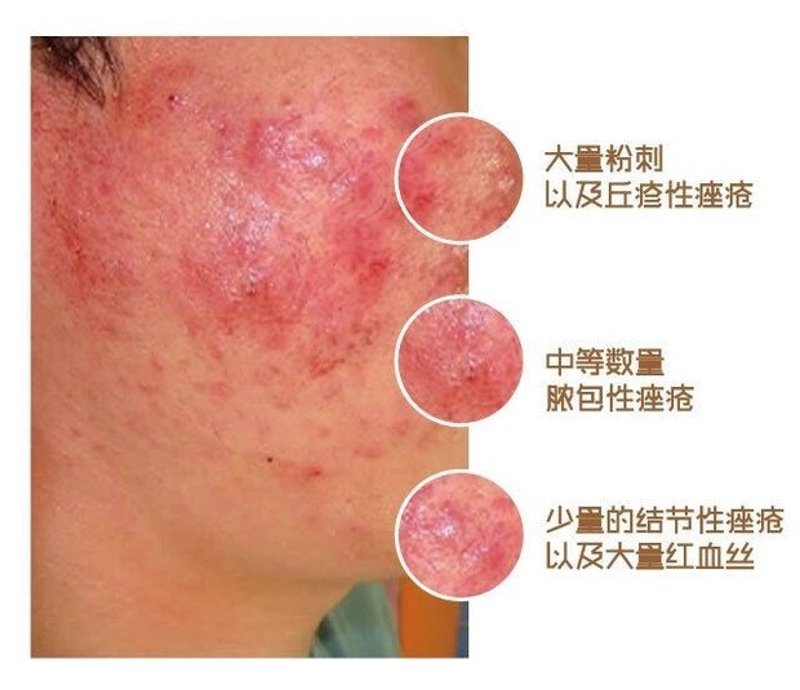 荨麻疹怎么治疗：中医角度解析